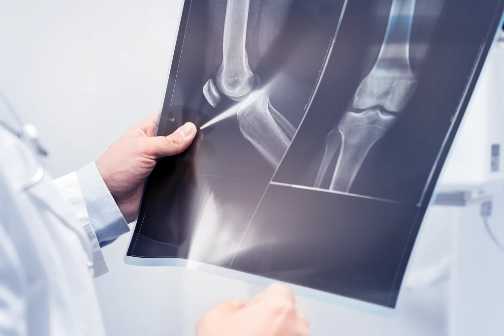 Knee ACL Xray